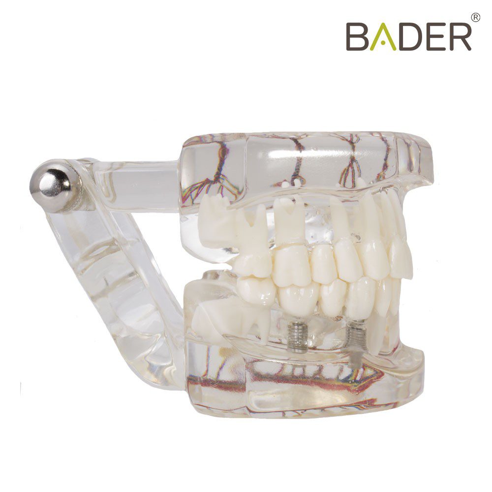 4063-Modelo-dental-de-implante-con-nervio.jpg