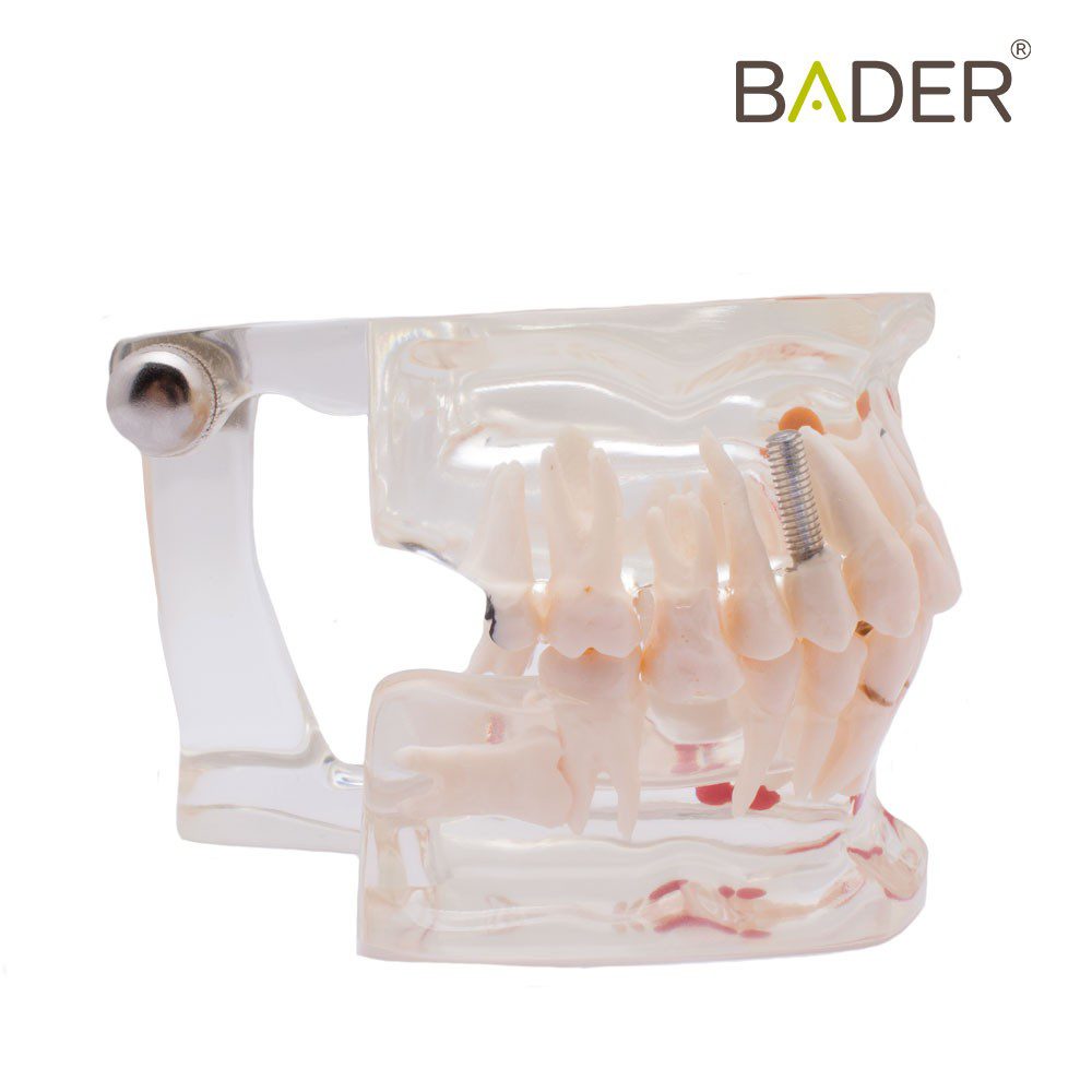 4551-Modelo-dental-transparente-con-implante.jpg